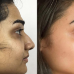 best rhinoplasty in bangalore