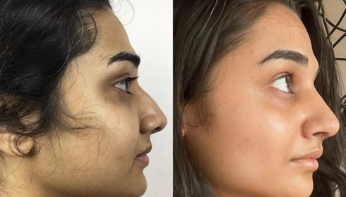 best rhinoplasty in bangalore